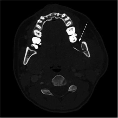 Osteomyelitis of the Jaw in COVID-19 Patients: A Rare Condition With a High Risk for Severe Complications